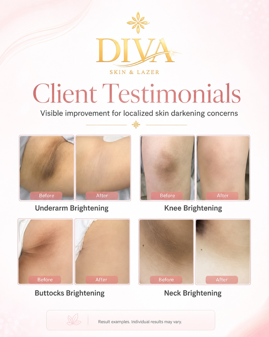 Body Skin & Intimate Treatments in Poipet at DIVA Skin Clinic Poipet
