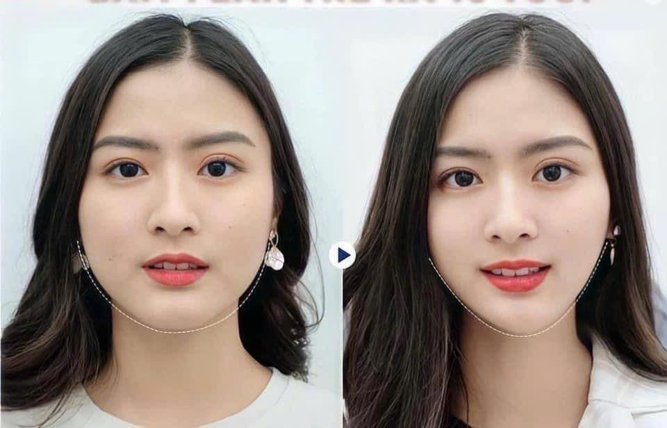 Botox