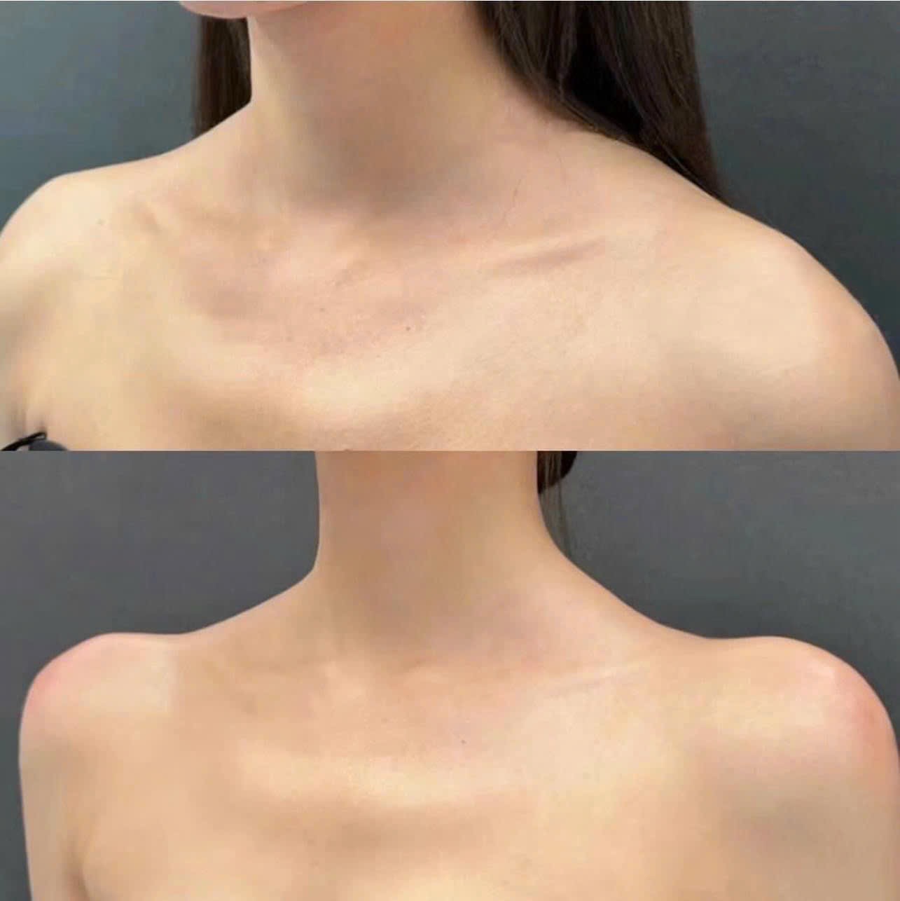 Botox vs Filler in Poipet