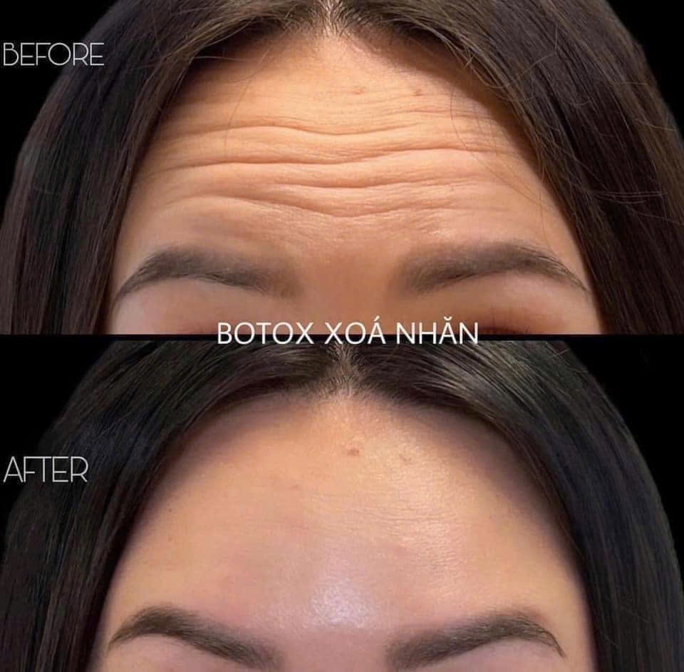 Botox Treatment image 22 at DIVA Skin Clinic Poipet