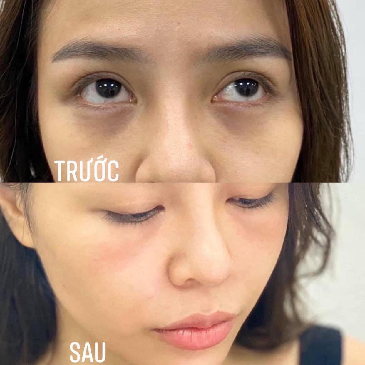 Botox Treatment image 29 at DIVA Skin Clinic Poipet