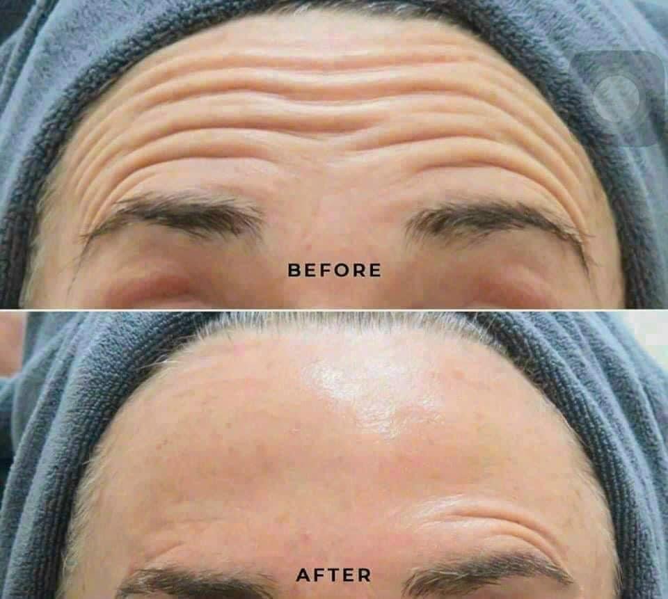 Botox Treatment in Poipet — image 8