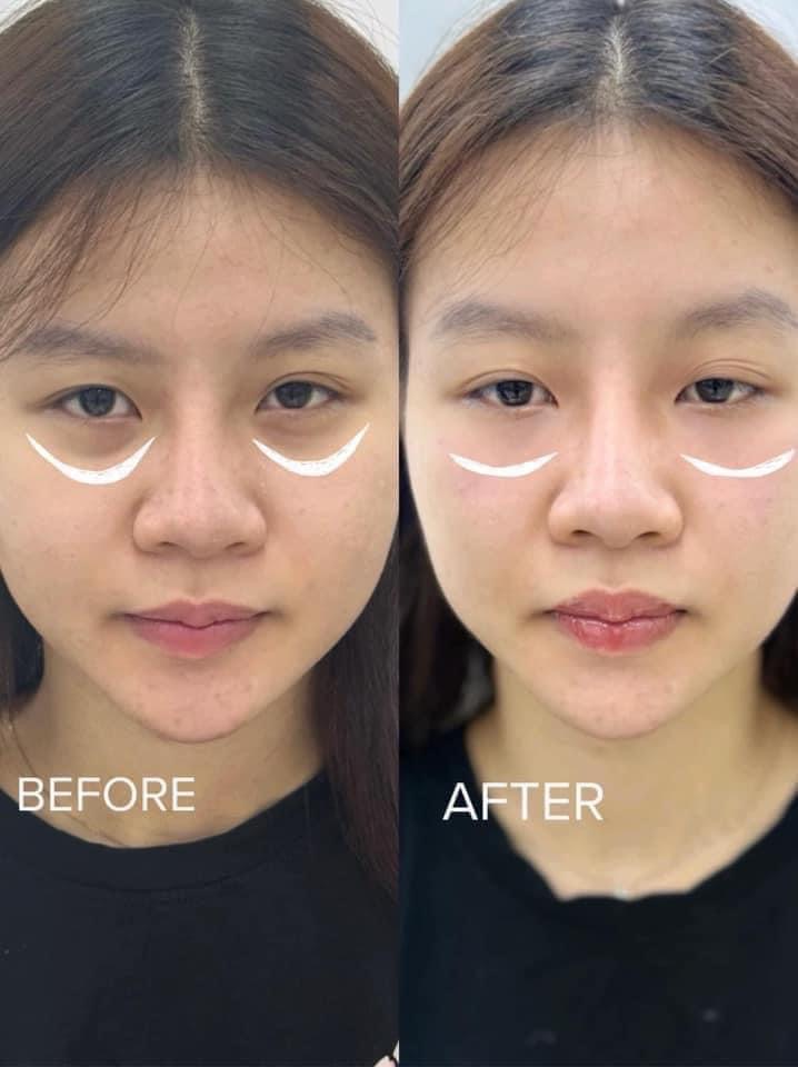 Dark Circles and Eye Rejuvenation image 2 at DIVA Skin Clinic Poipet