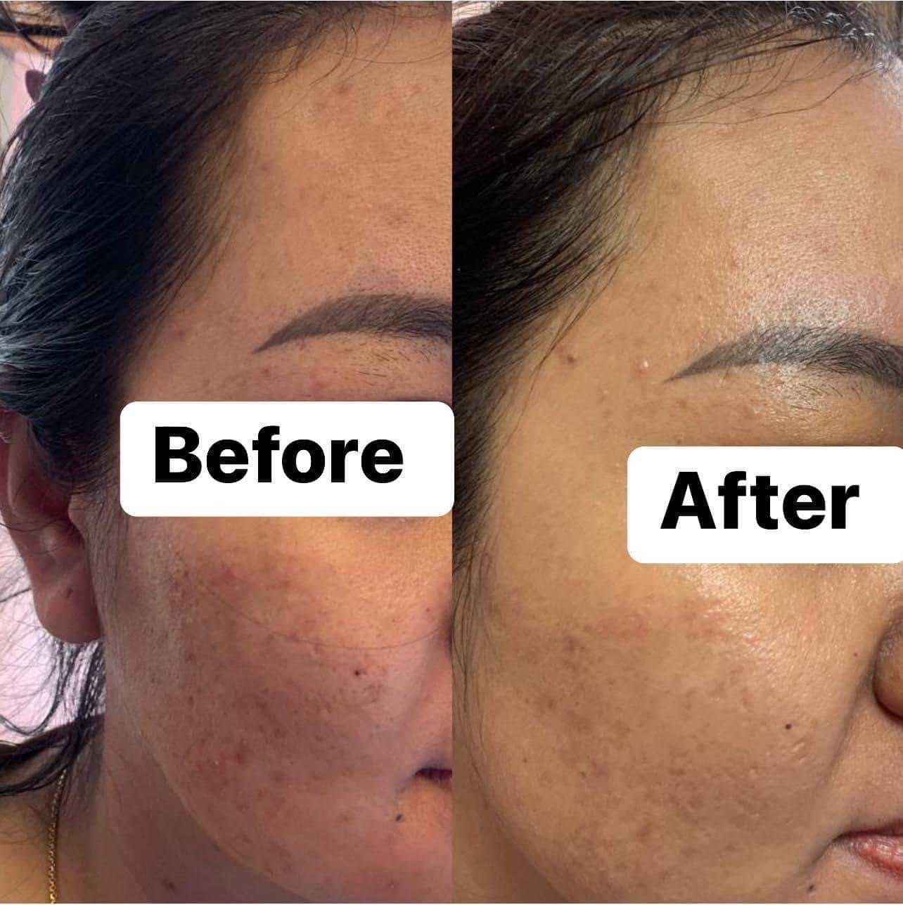 EYE TREATMENT at DIVA Skin Clinic Poipet