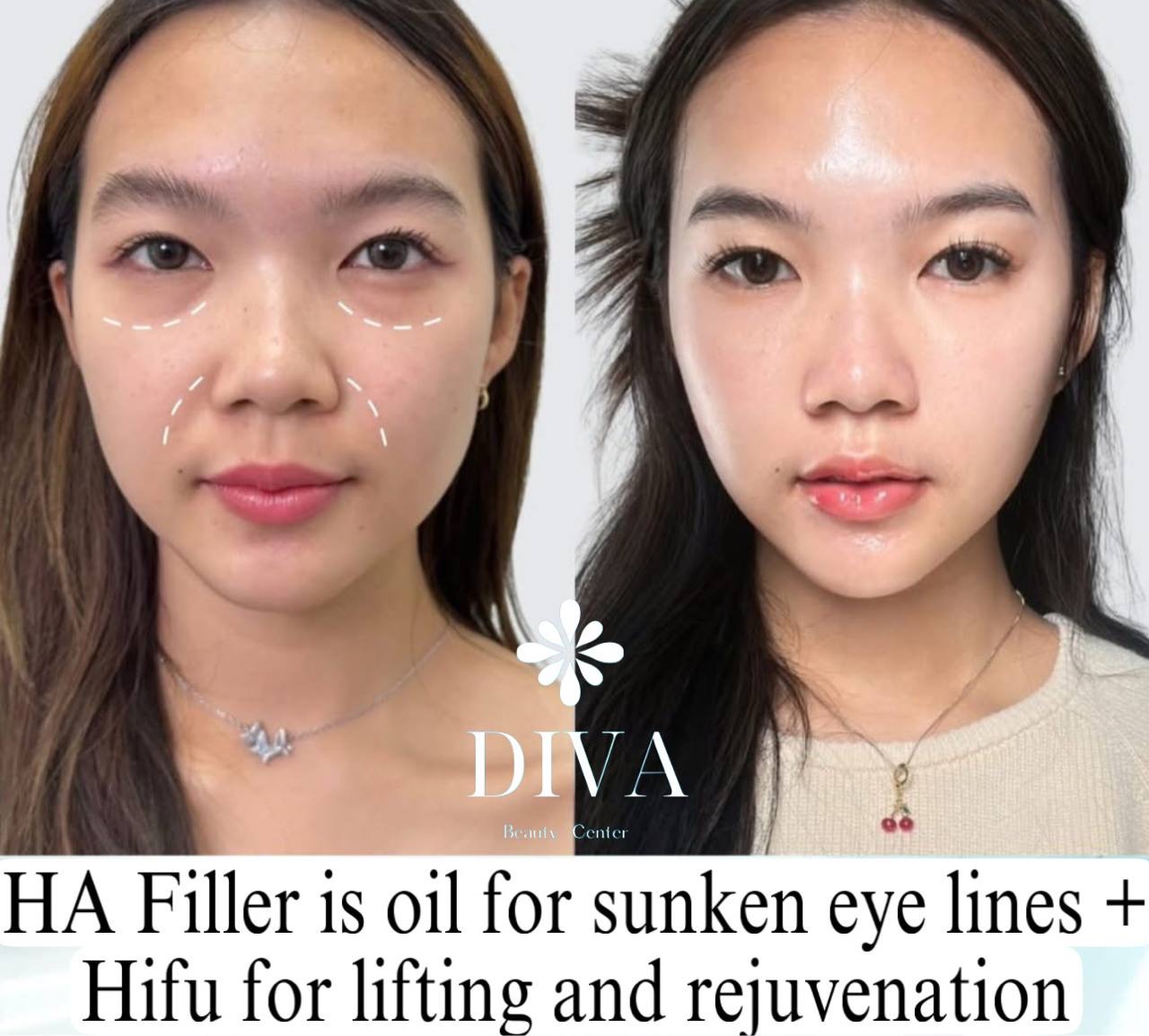Dermal Filler image 5 at DIVA Skin Clinic Poipet