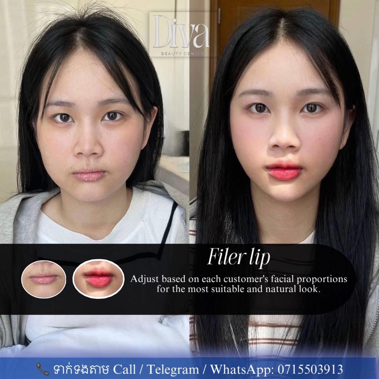 Skin Booster — Hydration and Better Skin Quality, but Not Filler
