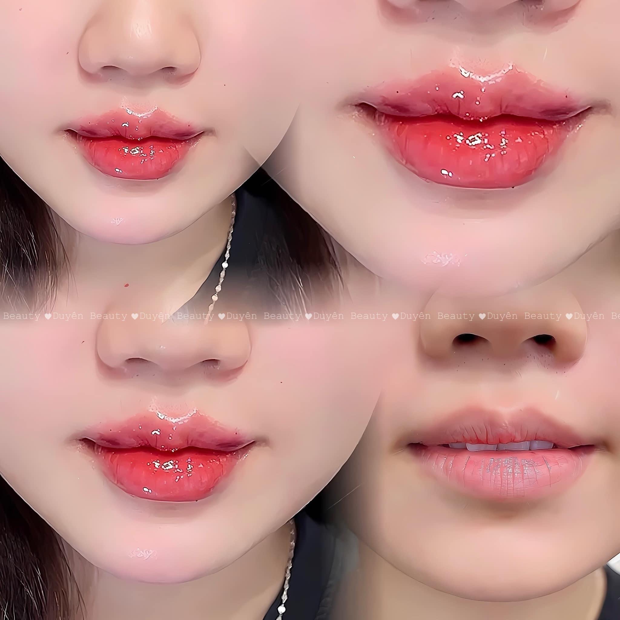 Filler Vascular Occlusion — Emergency Signs After Filler Injection