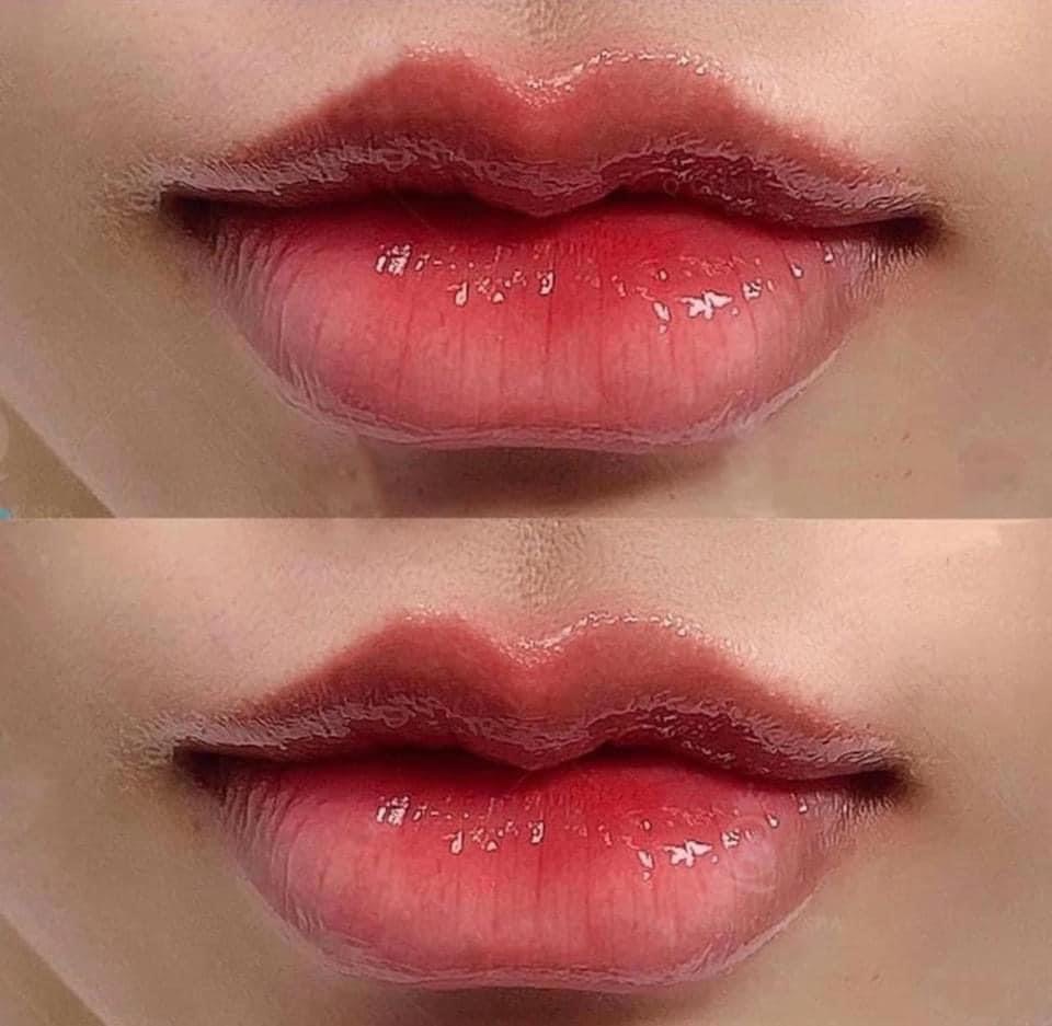 Dermal Filler image 11 at DIVA Skin Clinic Poipet
