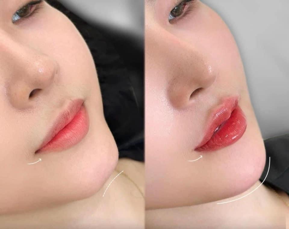Dermal Filler image 12 at DIVA Skin Clinic Poipet
