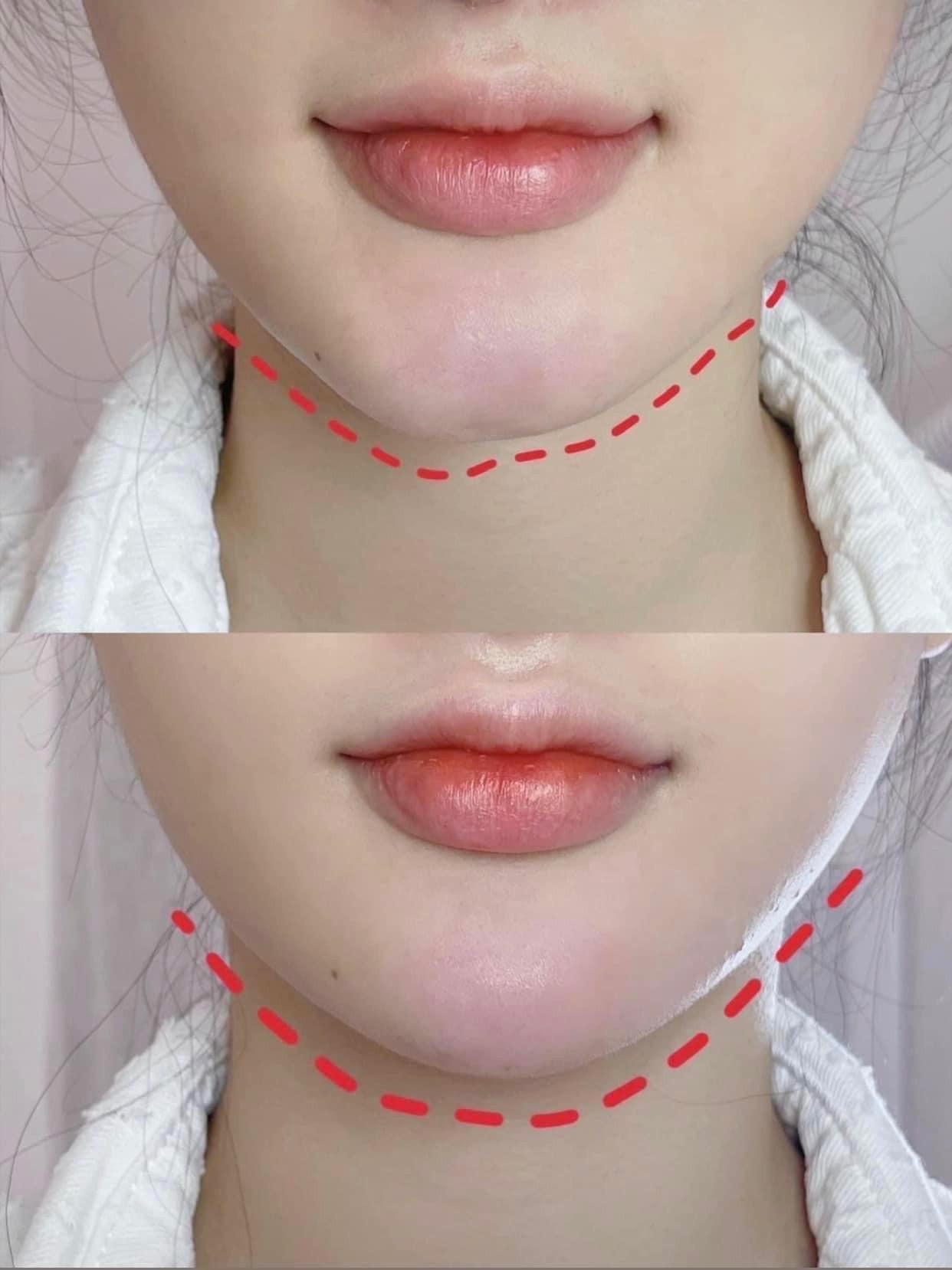 Dermal Filler image 13 at DIVA Skin Clinic Poipet