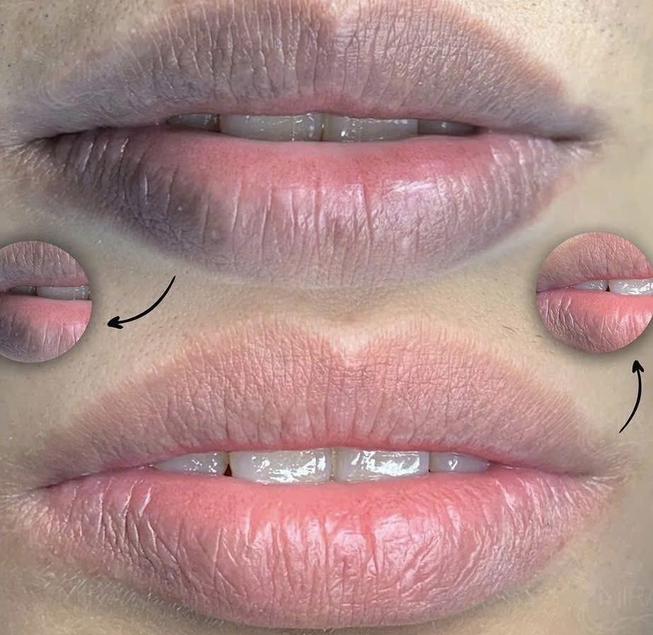 DERMAL FILLER at DIVA Skin Clinic Poipet