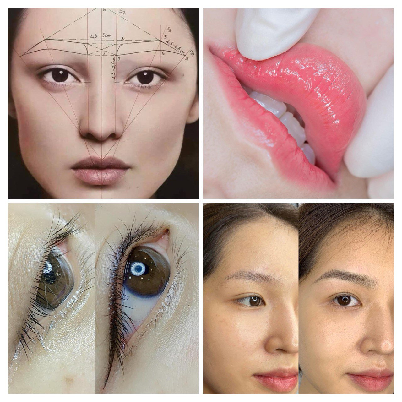 Dermal Filler image 3 at DIVA Skin Clinic Poipet