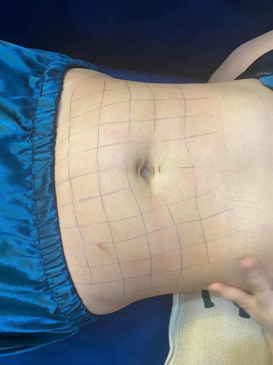 Fat Dissolving Body Contouring image 5 at DIVA Skin Clinic Poipet