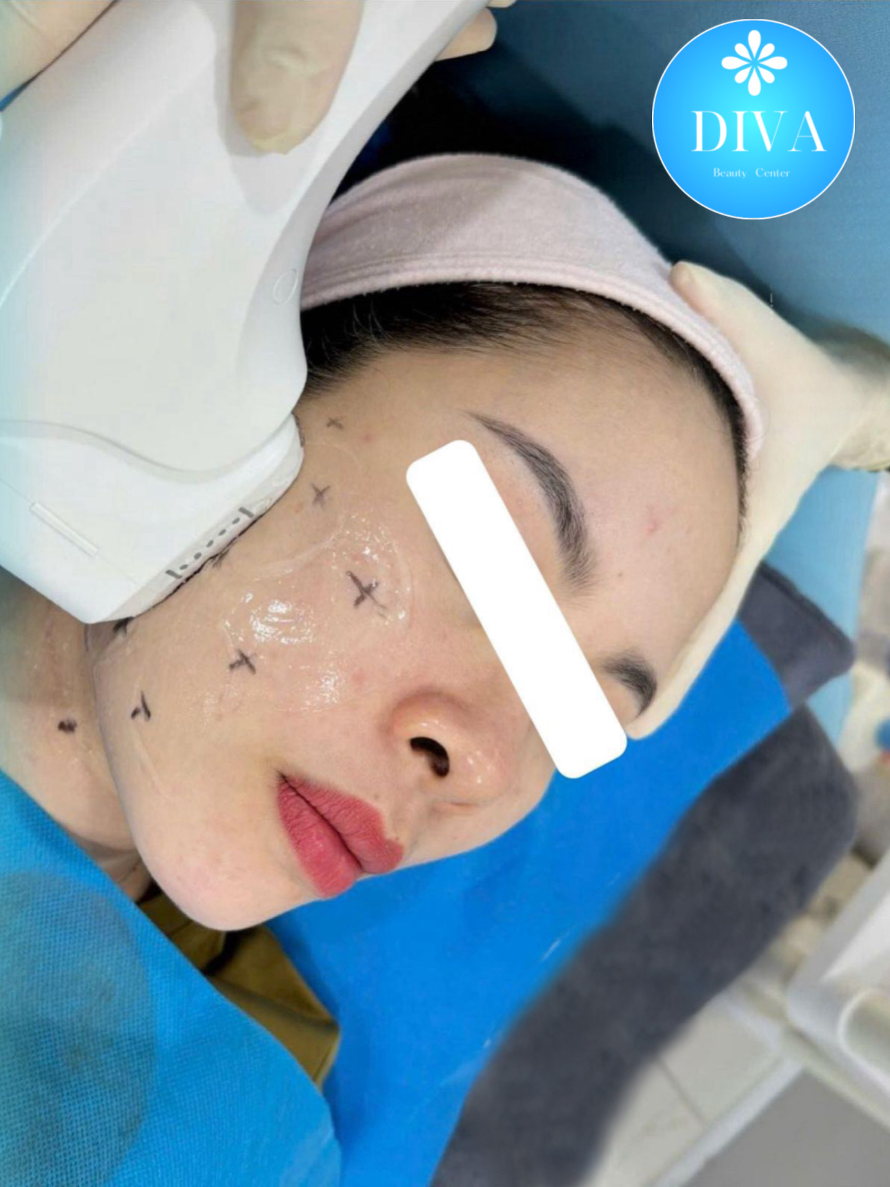 HIFU Lifting image 3 at DIVA Skin Clinic Poipet