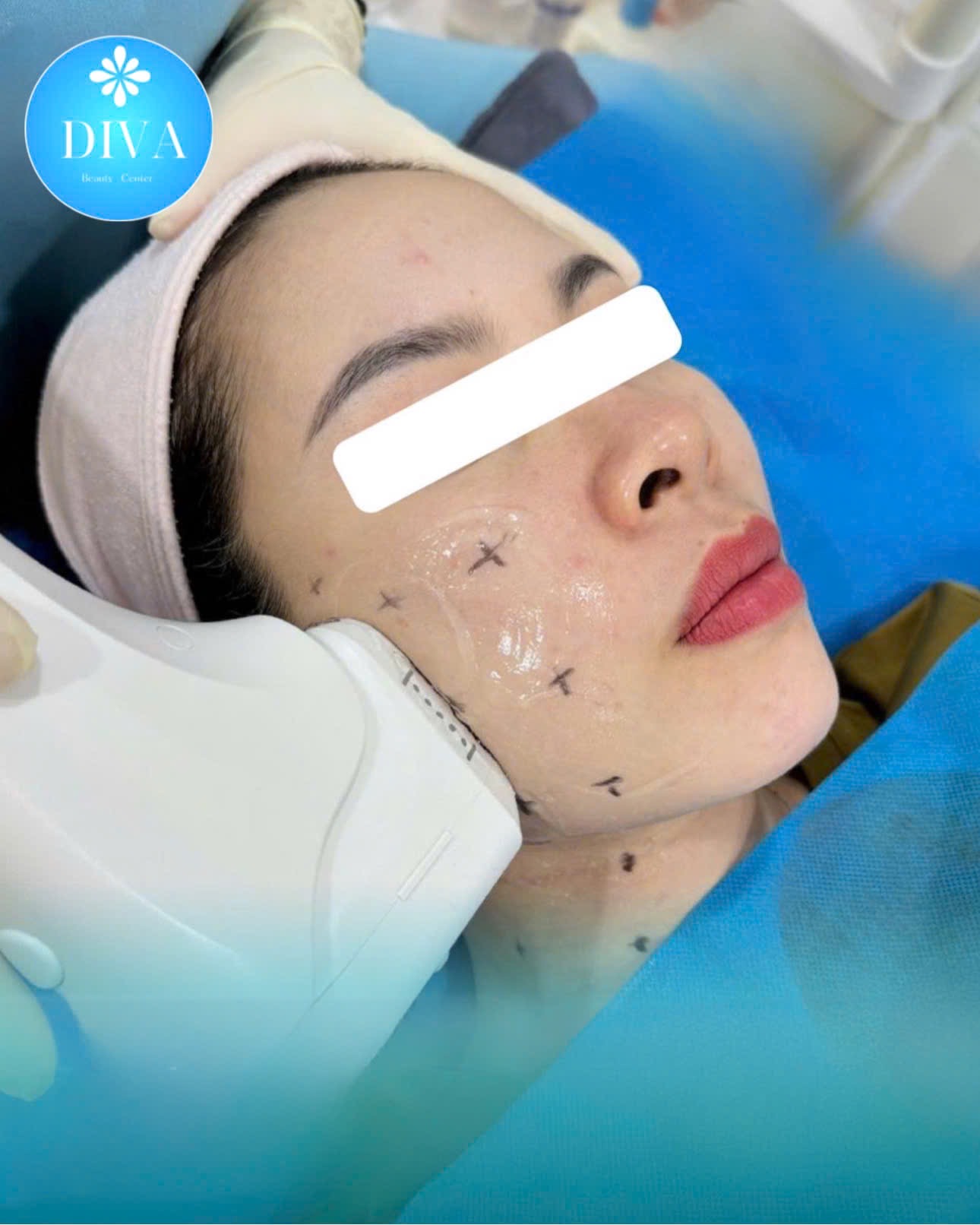 HIFU Lifting image 8 at DIVA Skin Clinic Poipet