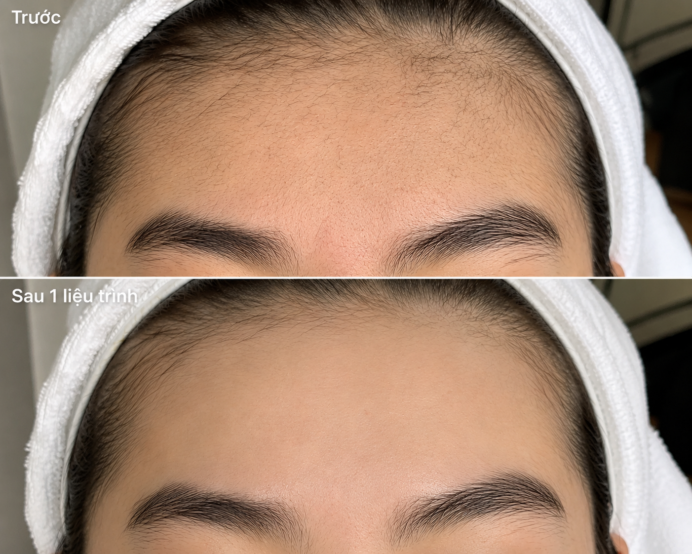 Laser Hair Removal image 2 at DIVA Skin Clinic Poipet