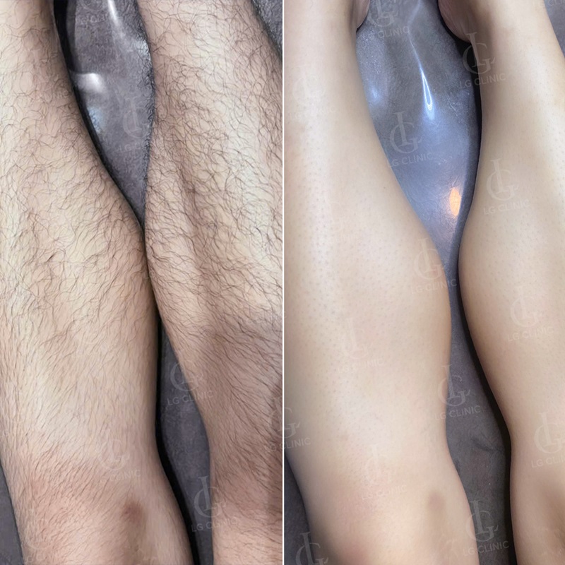 Laser Hair Removal image 3 at DIVA Skin Clinic Poipet