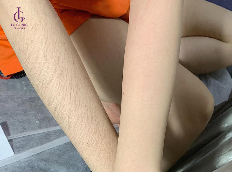Laser Hair Removal image 5 at DIVA Skin Clinic Poipet