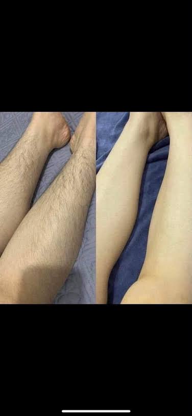 Laser Hair Removal image 7 at DIVA Skin Clinic Poipet