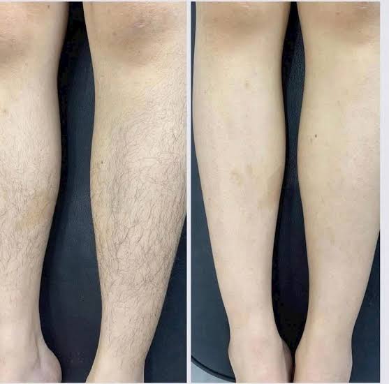 Laser Hair Removal image 8 at DIVA Skin Clinic Poipet