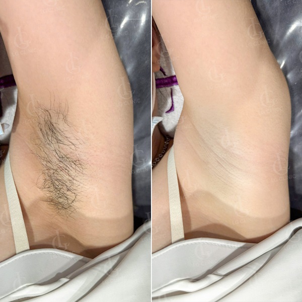 Laser Hair Removal