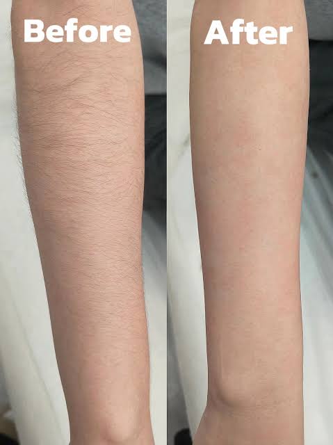 Laser Hair Removal image 10 at DIVA Skin Clinic Poipet