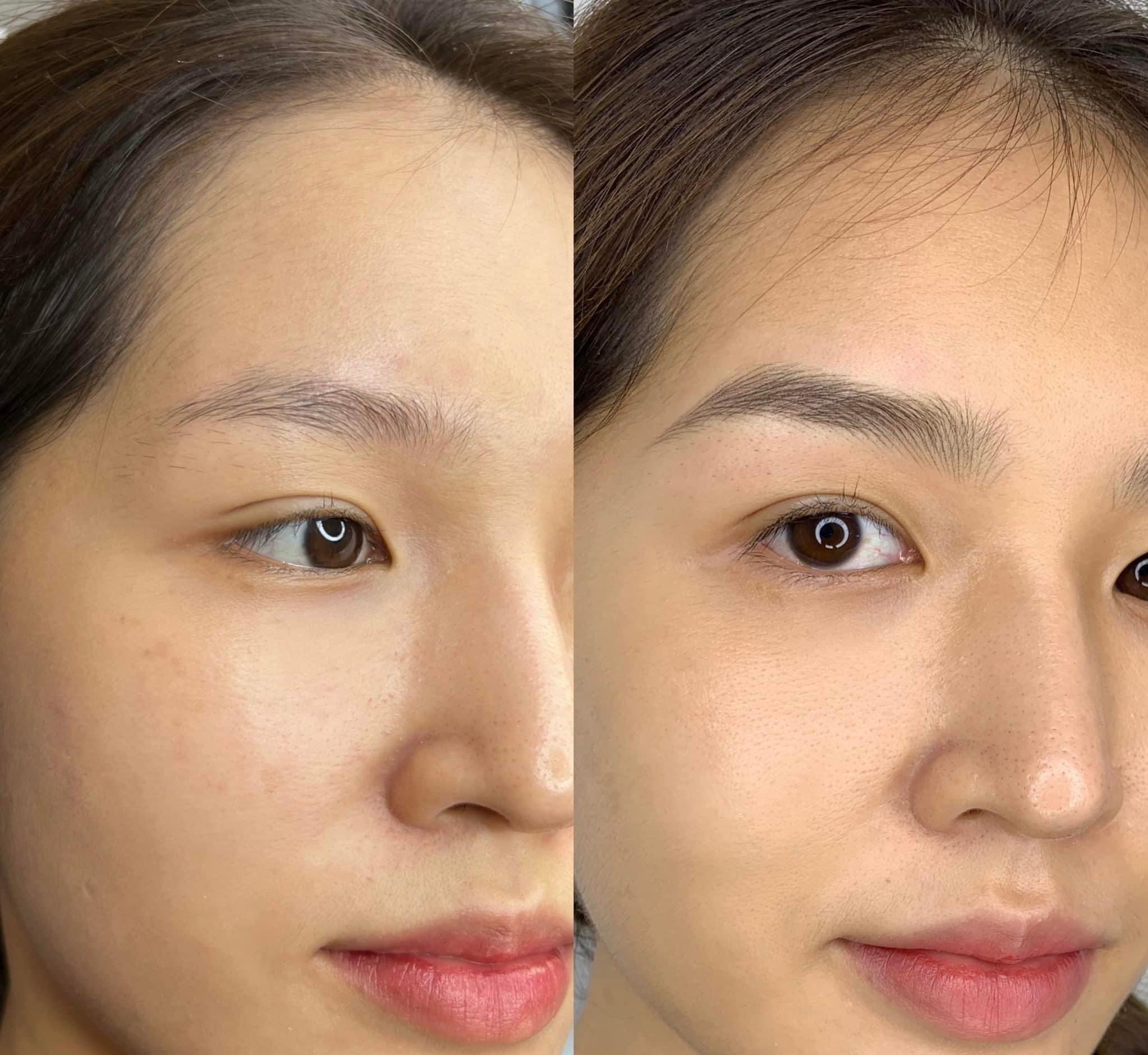 Permanent Makeup and Tattoo Removal image 4 at DIVA Skin Clinic Poipet