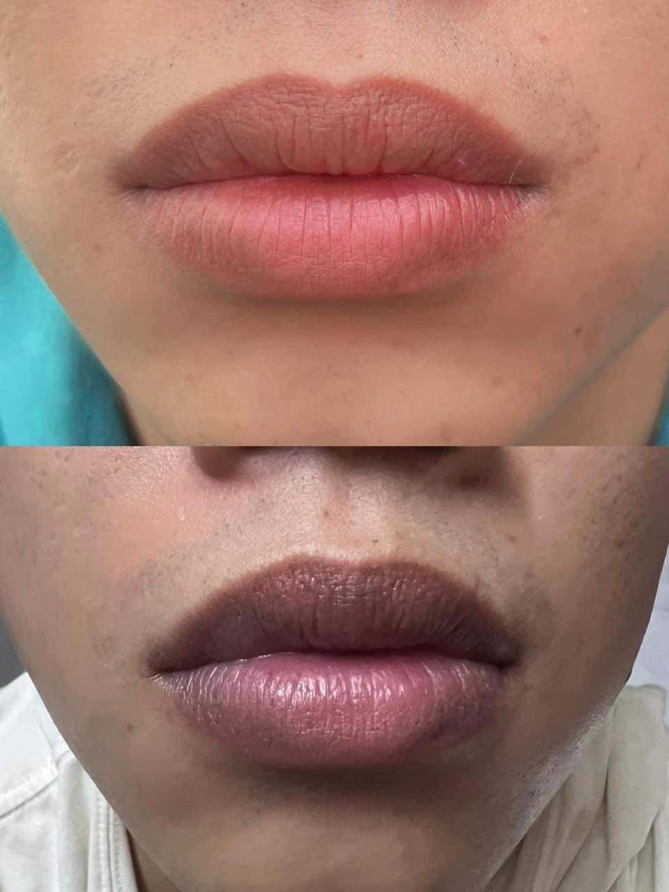 Permanent Makeup and Tattoo Removal image 7 at DIVA Skin Clinic Poipet