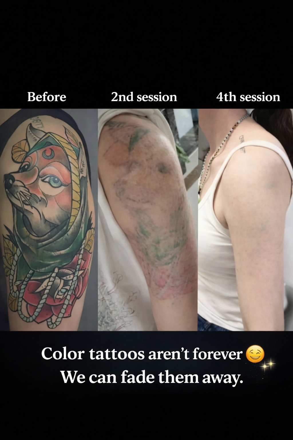 Permanent Makeup and Tattoo Removal image 9 at DIVA Skin Clinic Poipet