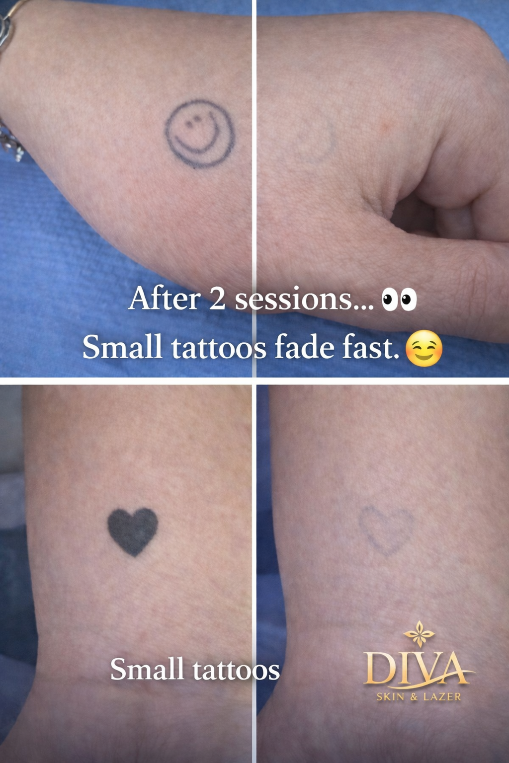Permanent Makeup and Tattoo Removal image 10 at DIVA Skin Clinic Poipet