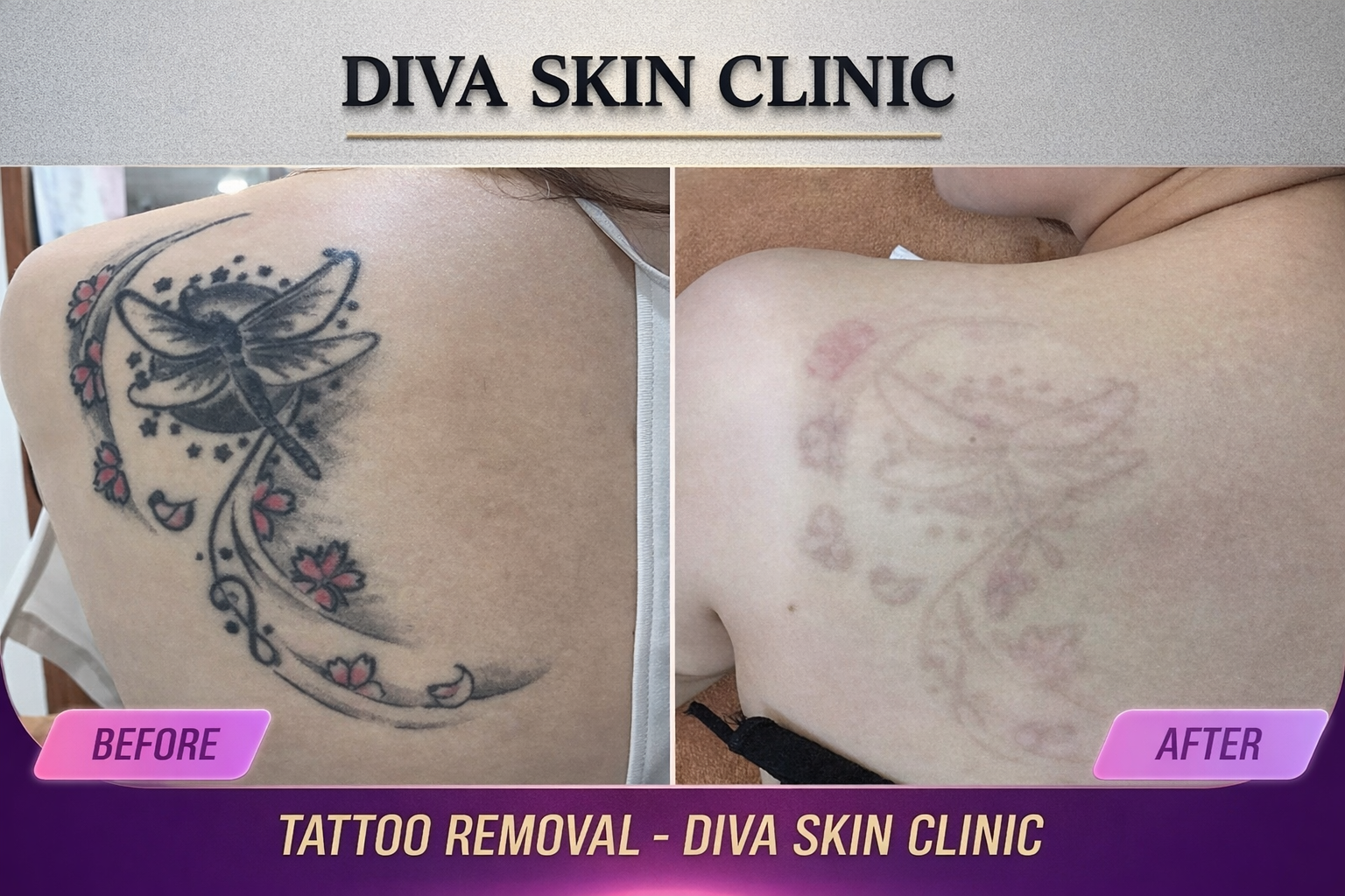 Permanent Makeup and Tattoo Removal image 13 at DIVA Skin Clinic Poipet