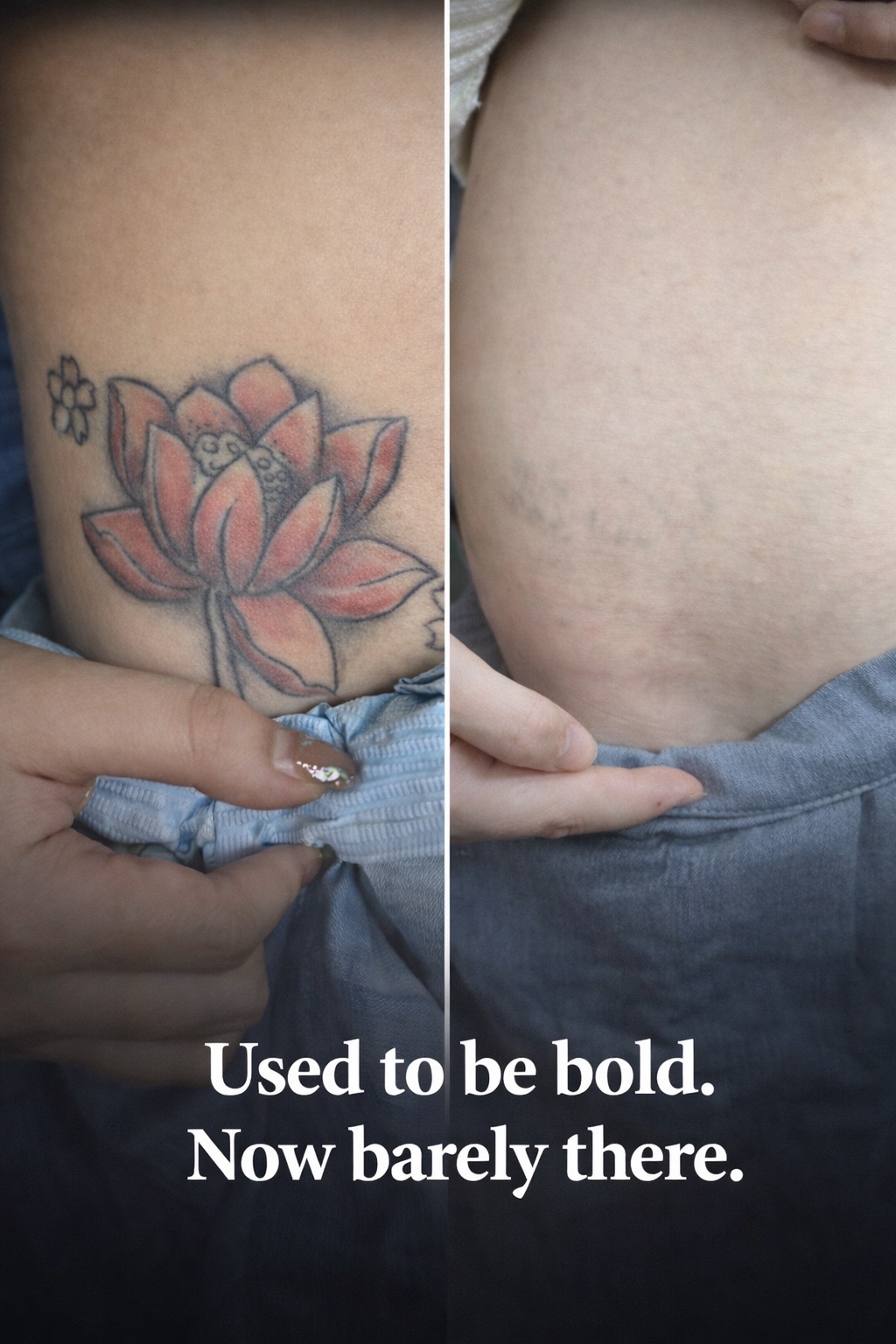 Permanent Makeup and Tattoo Removal image 14 at DIVA Skin Clinic Poipet