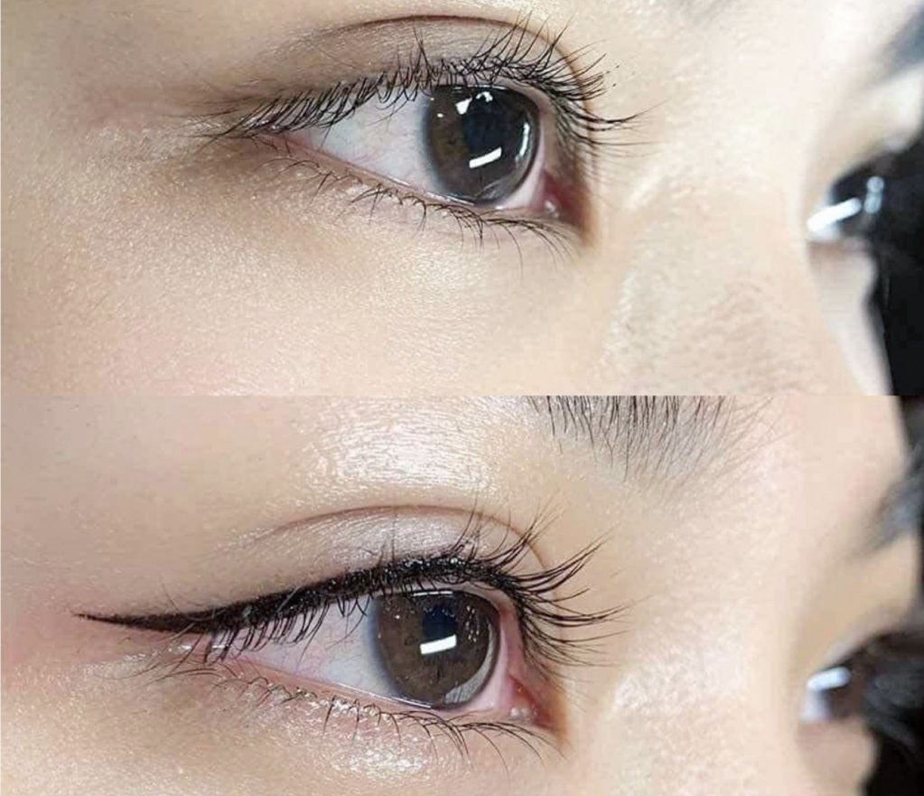 Permanent Makeup and Tattoo Removal image 17 at DIVA Skin Clinic Poipet