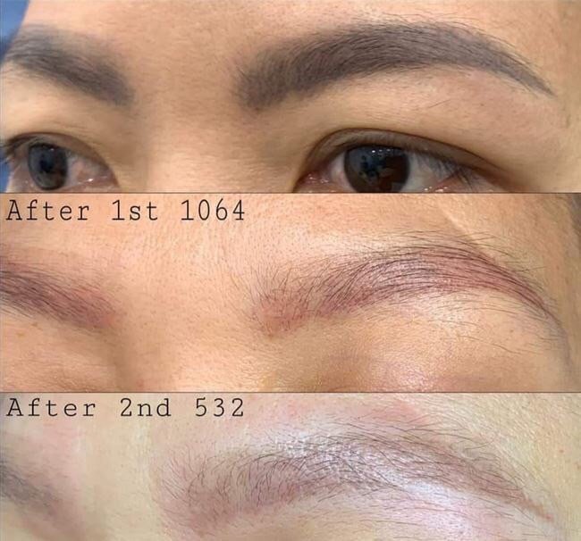 Before and after eyebrow laser and pigment correction at DIVA Skin Clinic Poipet