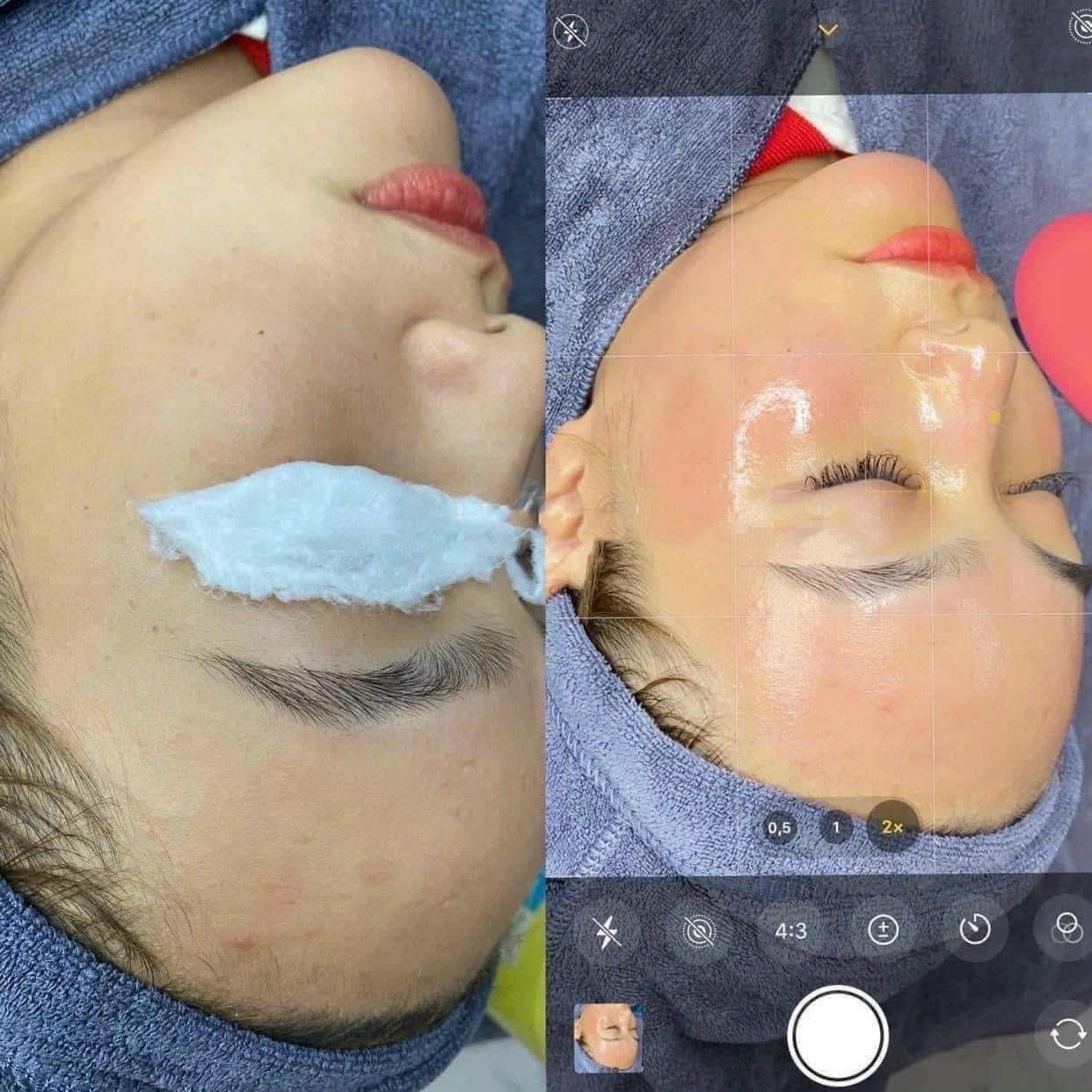 PRP, Scar Treatment & Keloid Injection in Poipet — image 6
