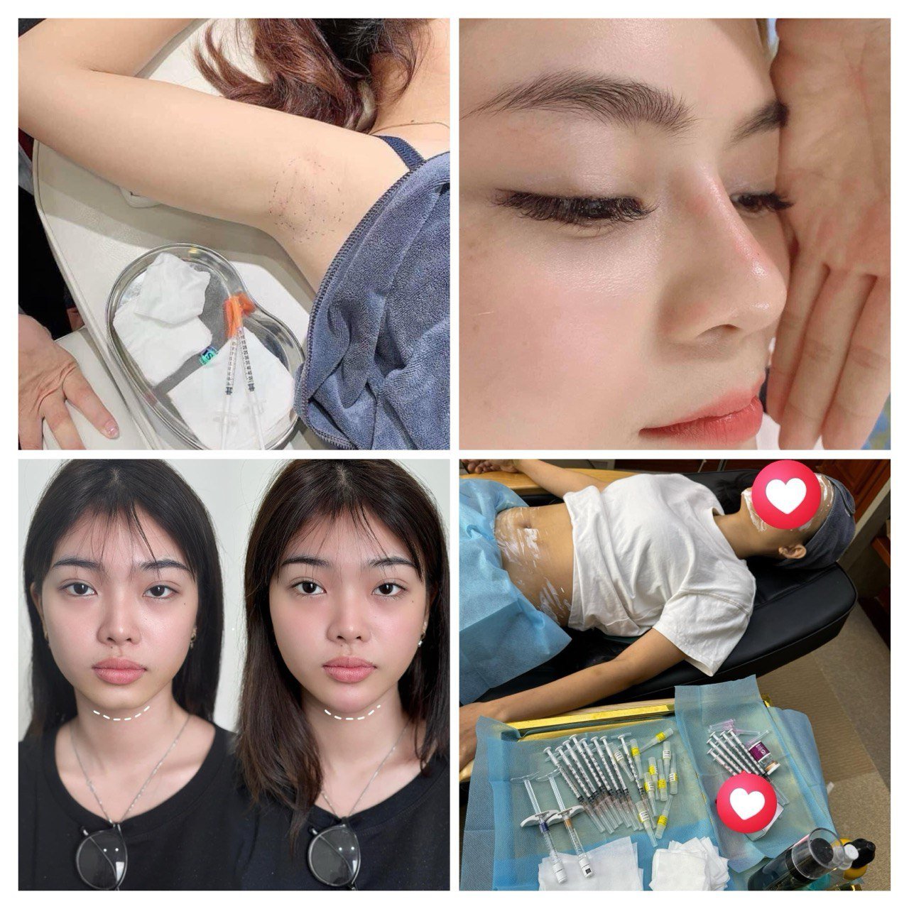 PRP, Scar Treatment & Keloid Injection in Poipet — image 7