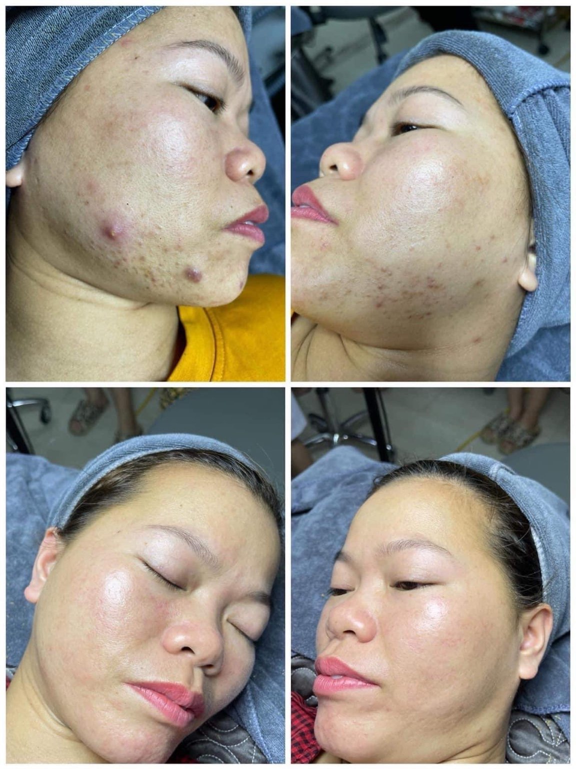 PRP, Scar Treatment & Keloid Injection in Poipet — image 8