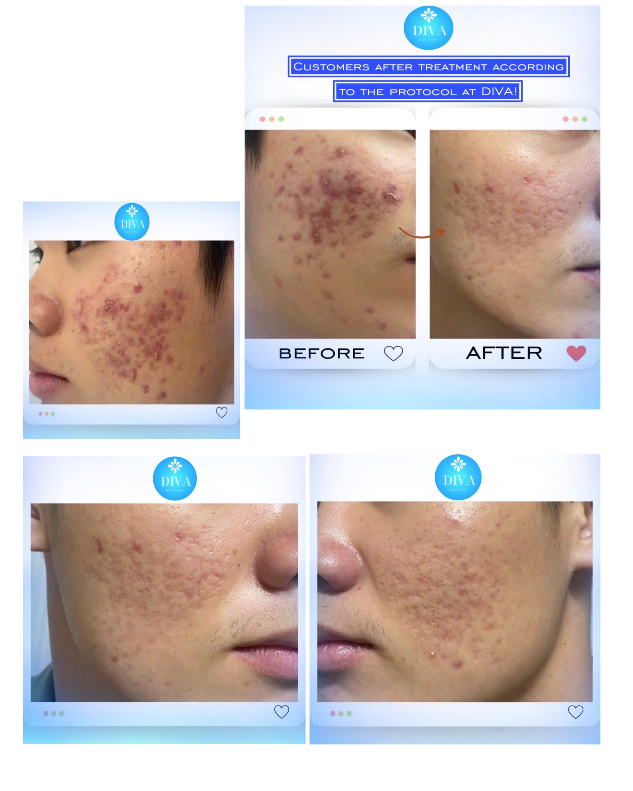 SKIN TREATMENTS at DIVA Skin Clinic Poipet