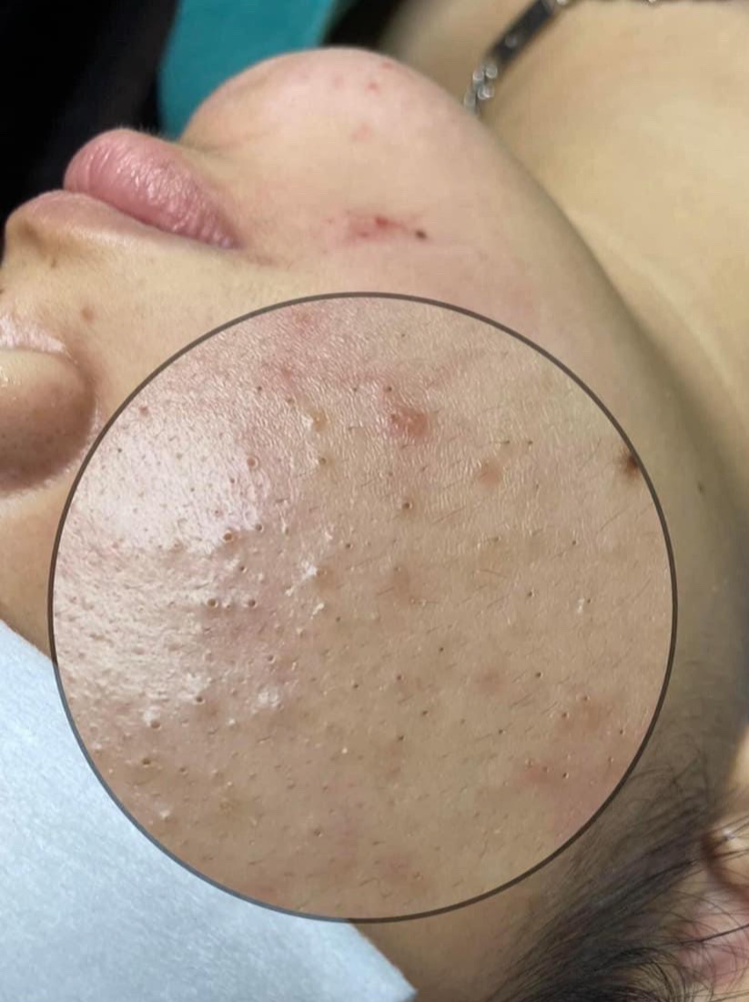 When Does DIVA Change the Treatment Stage?