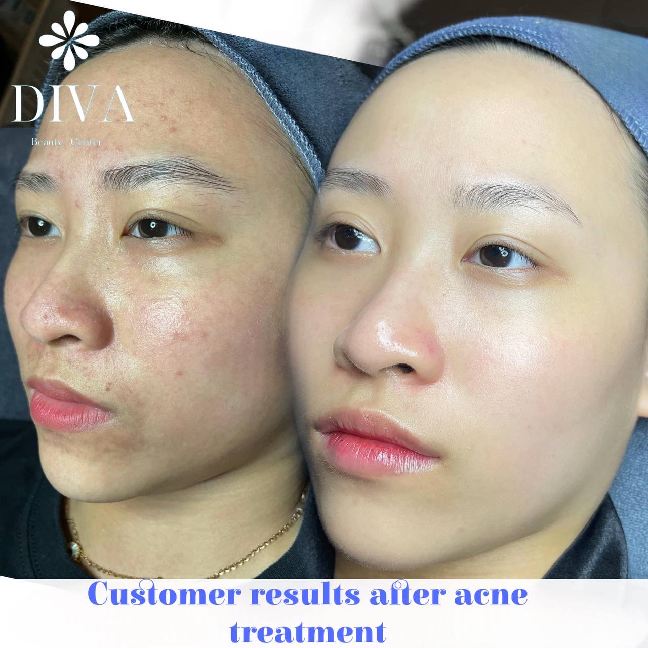Skin Treatment image 24 at DIVA Skin Clinic Poipet