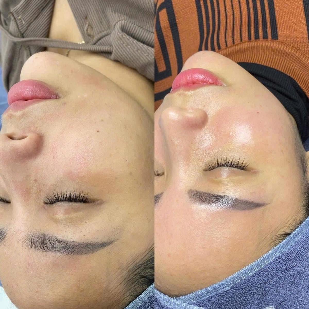 Why do many people start developing acne after living in Poipet for a while?