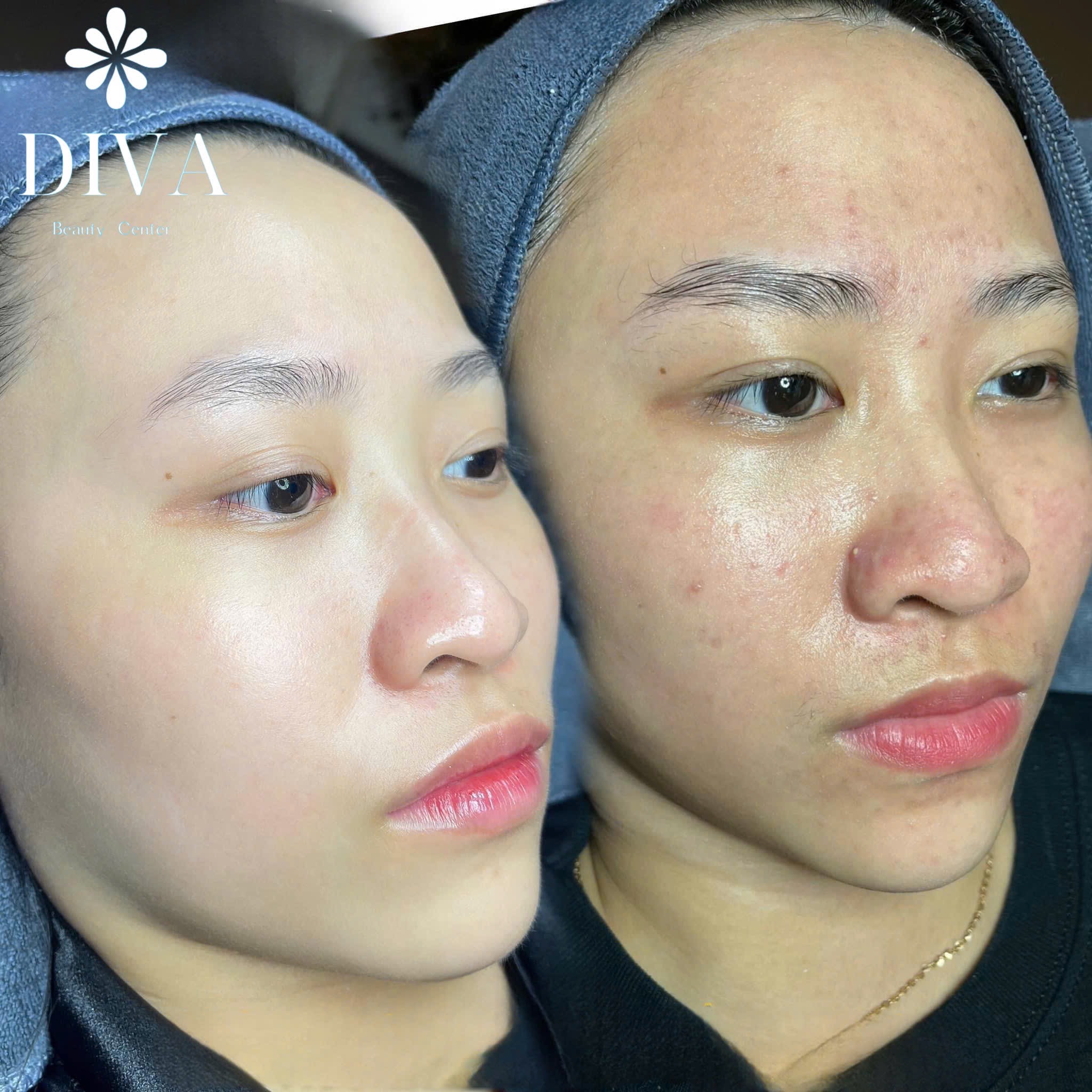 Enlarged Pores — Can They Really Be Made Completely Smaller?