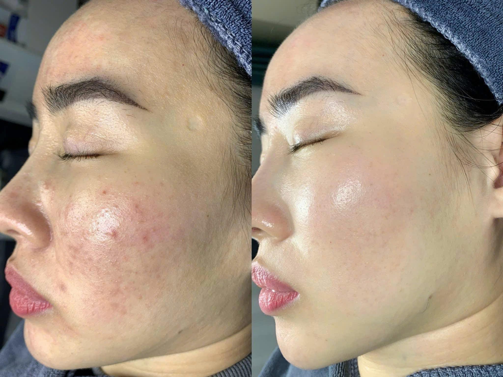 Skin Treatment image 41 at DIVA Skin Clinic Poipet