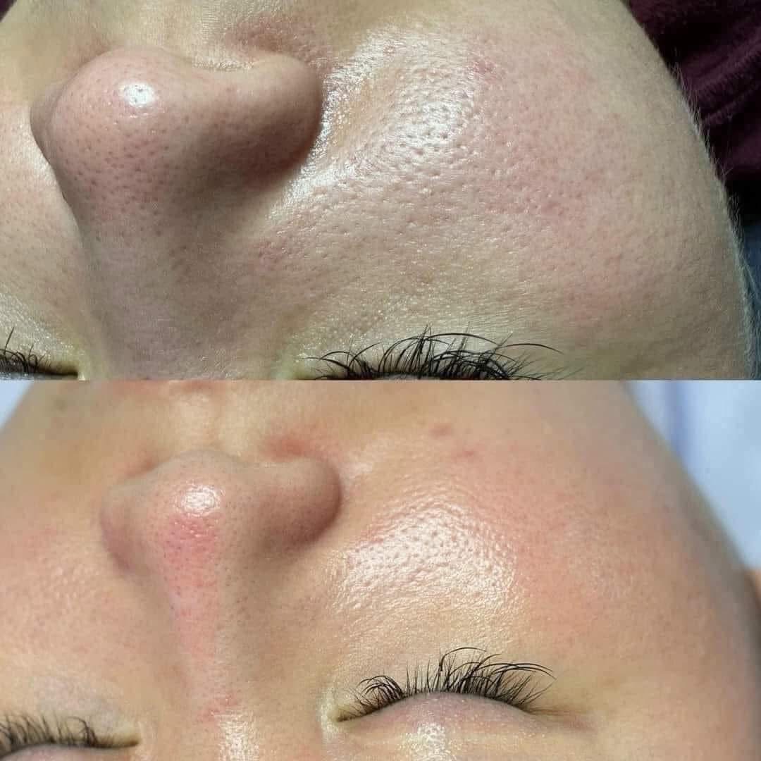 Why Do Breakouts Appear After Laser?