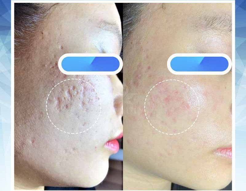Skin Treatment image 59 at DIVA Skin Clinic Poipet