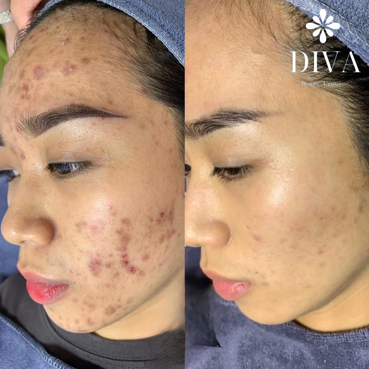 Skin Treatment image 63 at DIVA Skin Clinic Poipet
