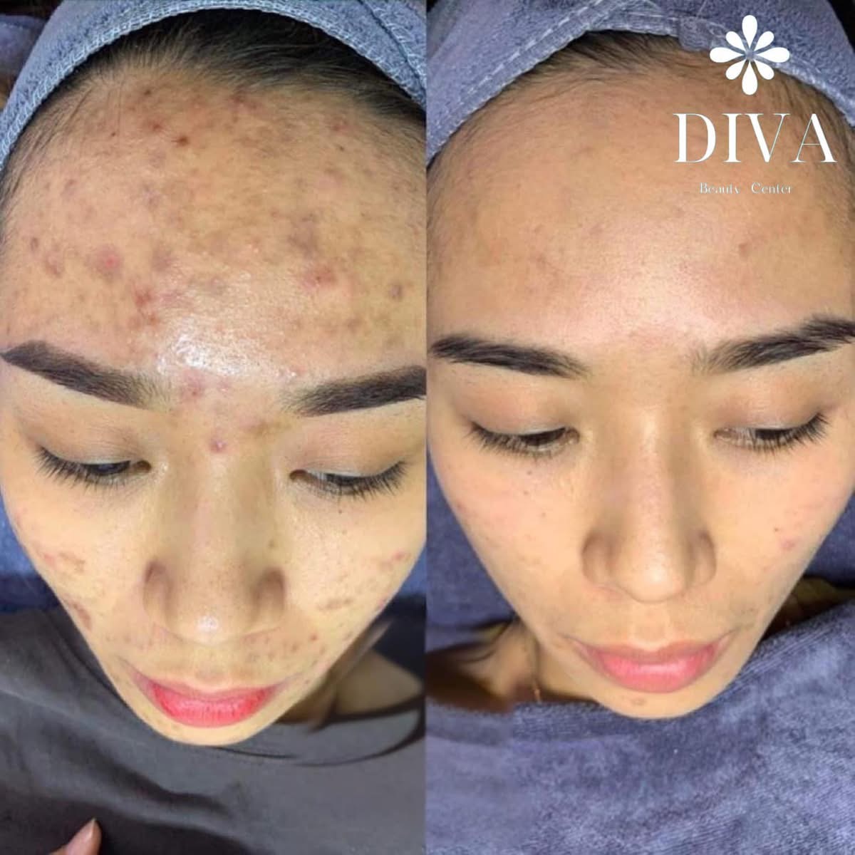 Skin Treatment image 64 at DIVA Skin Clinic Poipet