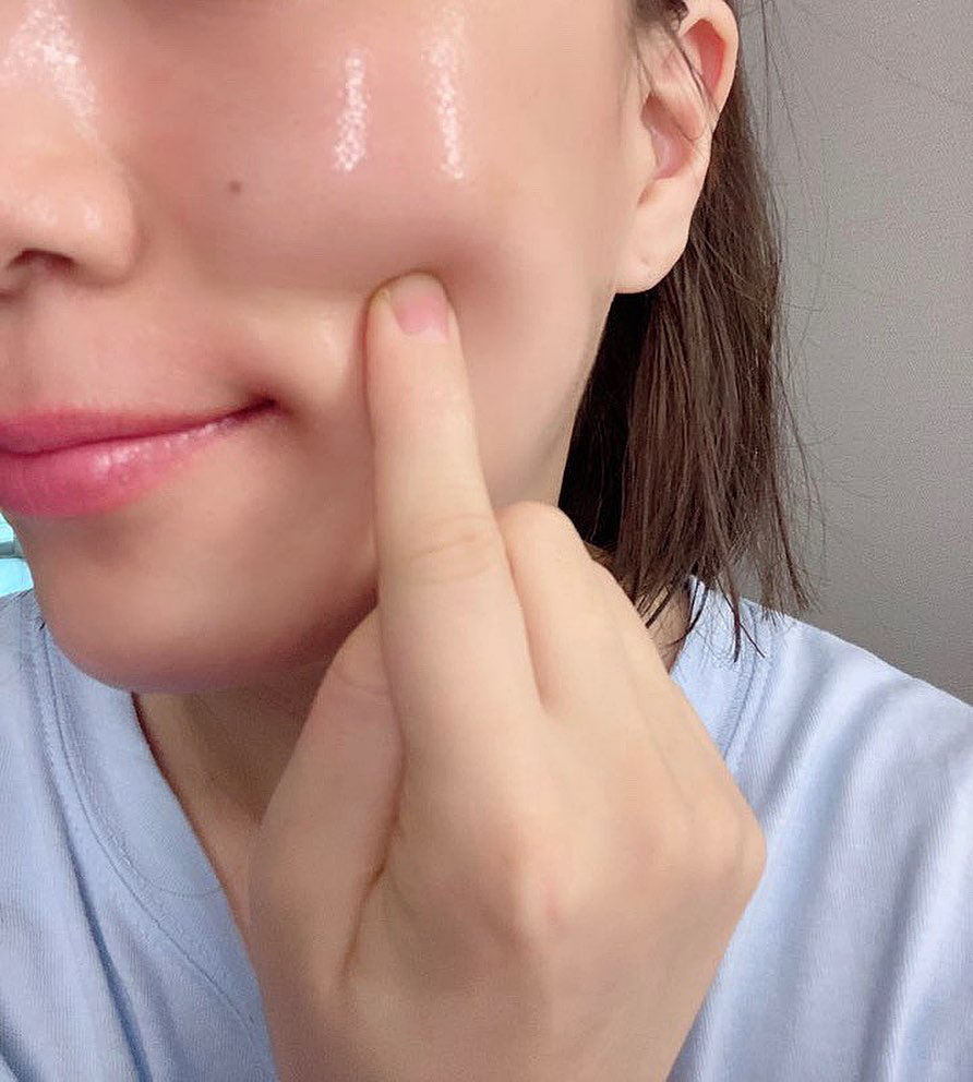 Acne Scar Treatment in Poipet