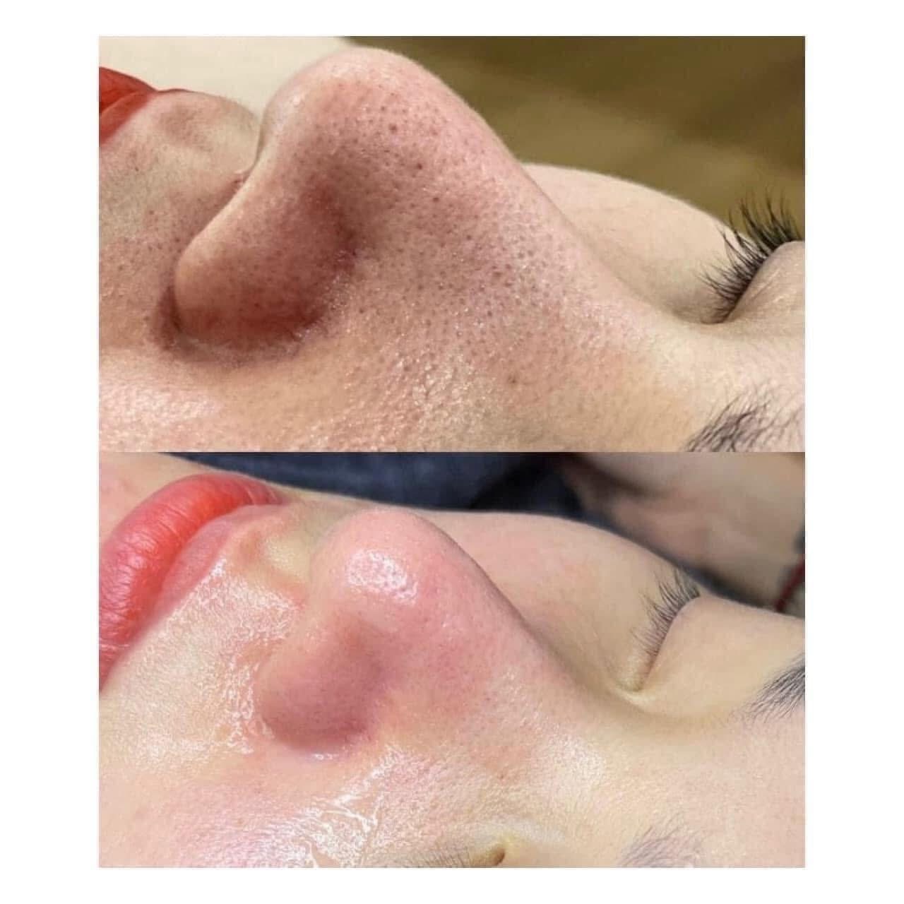 Pores and Rough Skin Texture Treatment in Poipet