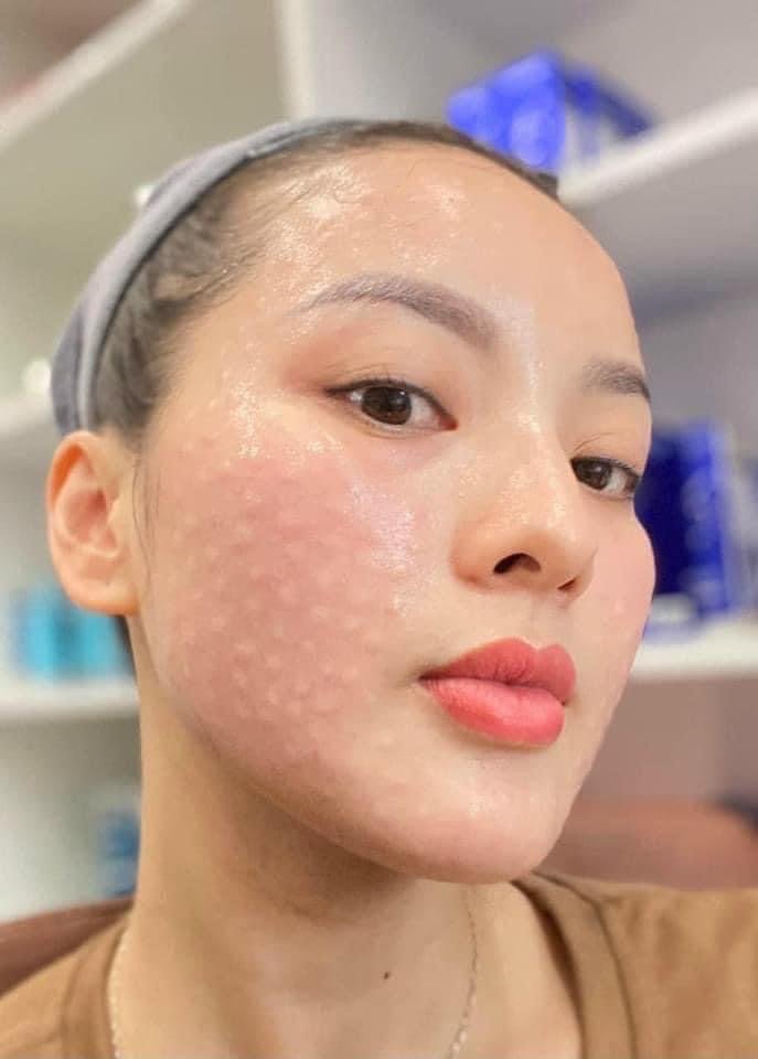 Skin Treatment image 76 at DIVA Skin Clinic Poipet